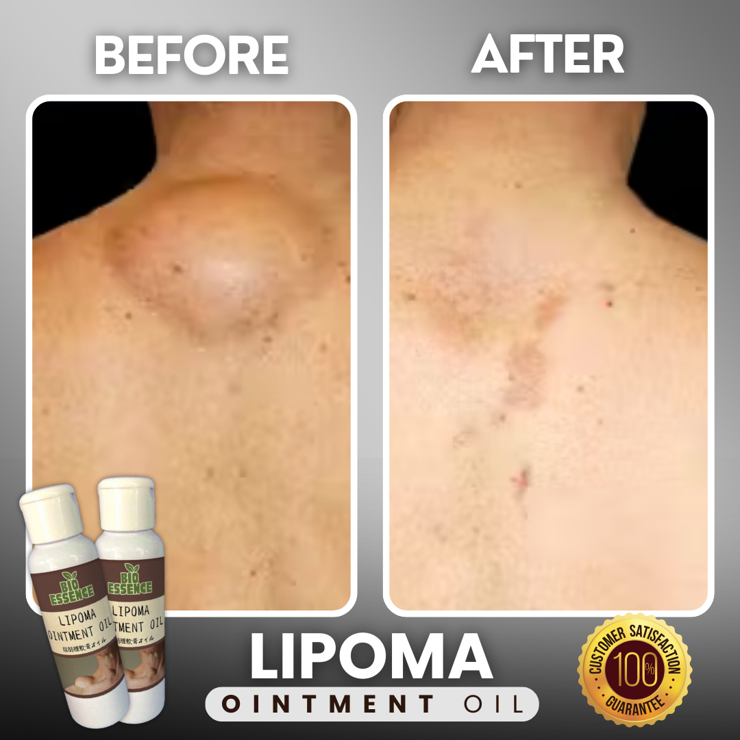 Lipoma Ointment Oil