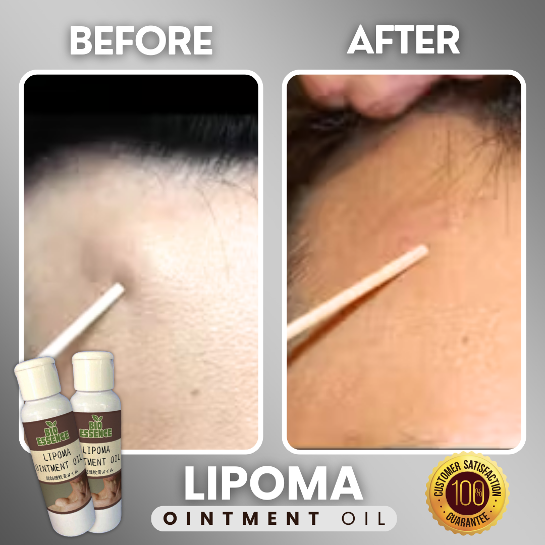 Lipoma Ointment Oil