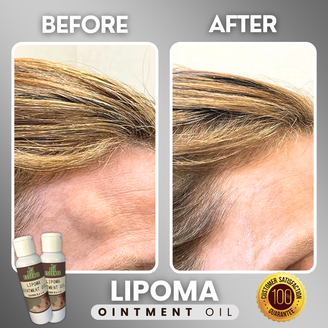 Lipoma Ointment Oil