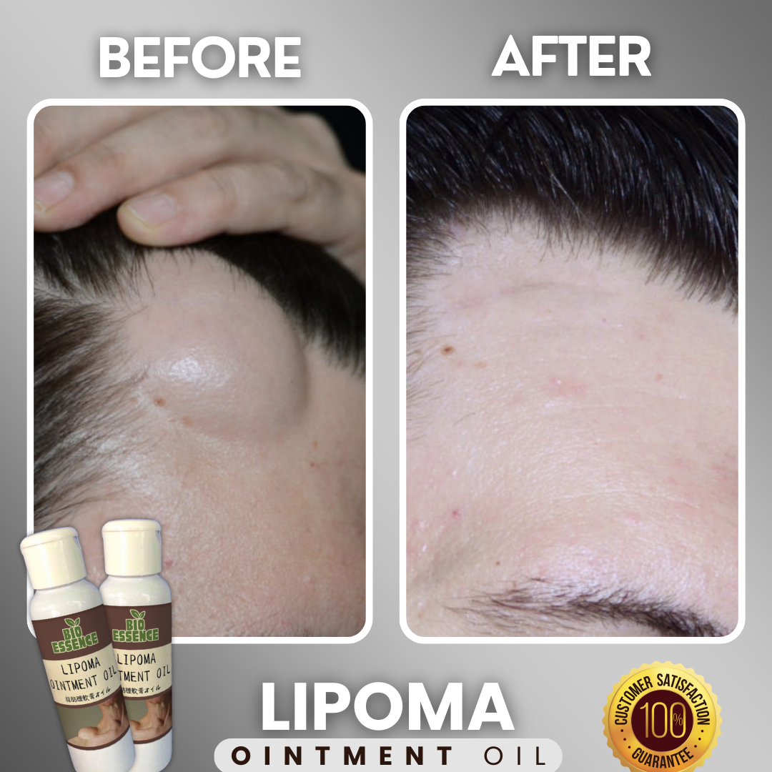 Lipoma Ointment Oil