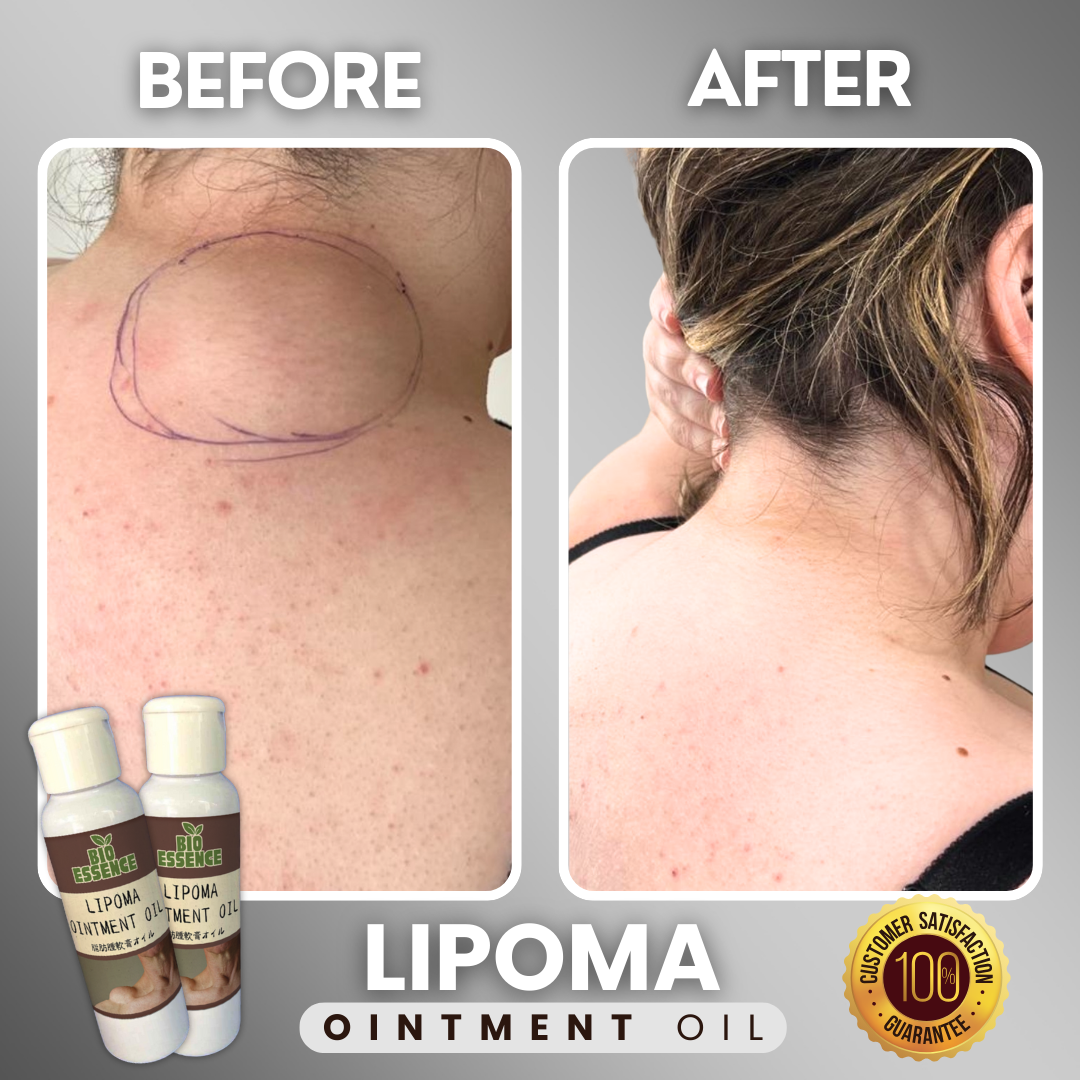 Lipoma Ointment Oil